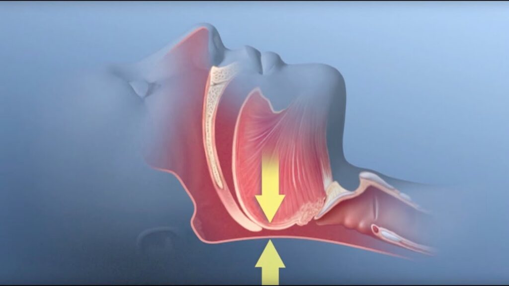 What Is Obstructive Sleep Apnoea?